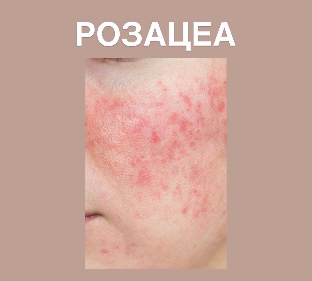 Rosacea: causes and what actually helps